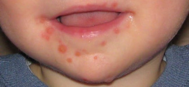 Sindrome mão pé boca